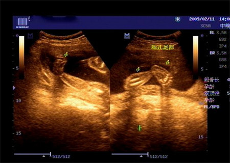 四维双足内翻宝宝能不能要,四维查出胎儿足内翻后期会长好吗