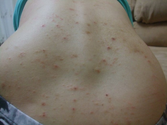 婴儿母乳过敏母亲怎么治疗,牛奶过敏的孩子如何母乳喂养