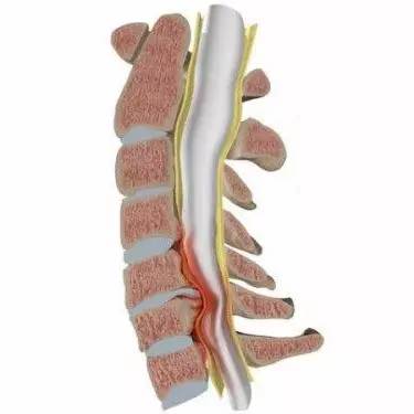 颈椎病分7种快来看看你是哪一类,颈椎病常见的这五种分型您了解吗