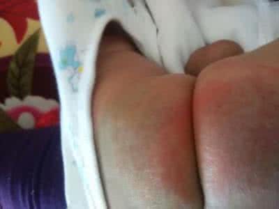 宝宝红屁股育婴师处理方法,新手妈妈红屁股怎么办