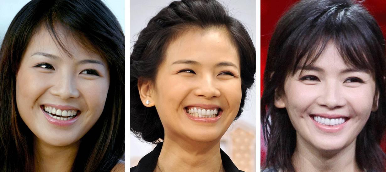 刘涛全瓷牙经验之谈,刘涛全牙美白