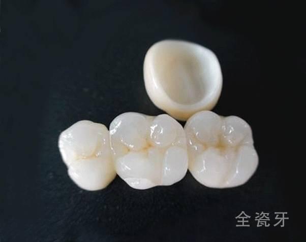 刘涛全瓷牙经验之谈,刘涛全牙美白