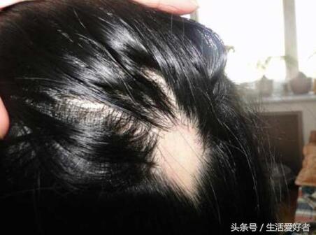 生发止脱发最快的方法,脱发剃光头用什么方法能生发
