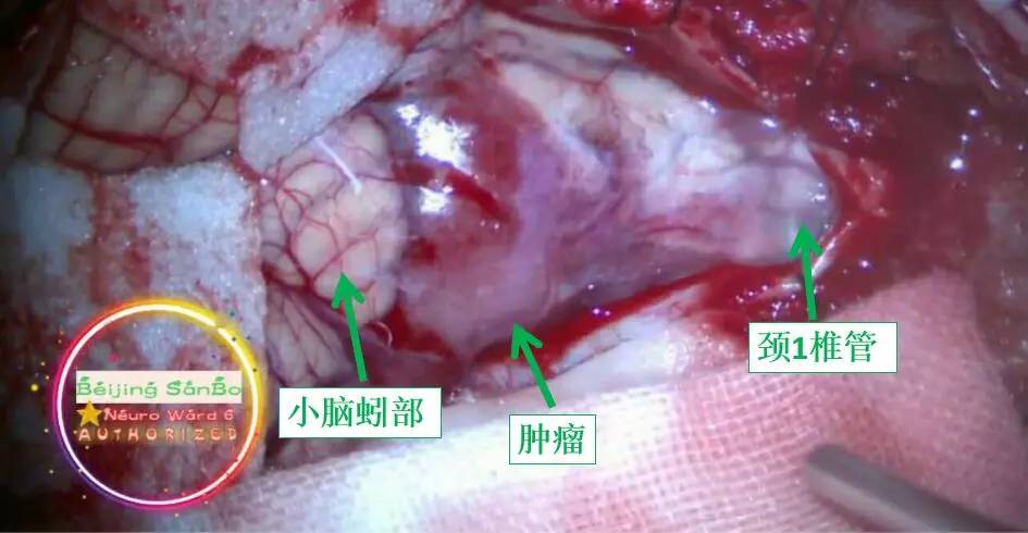 喝水容易呛是怎么回事是肺癌,老人喝水容易呛咳怎么办