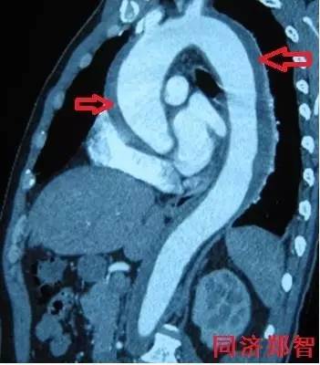 主动脉夹层差点要了老公的命,主动脉夹层兄妹