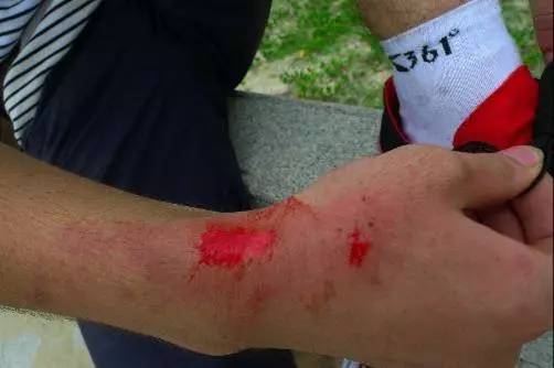 运动防护和急救小知识,运动伤害防护与急救知识点