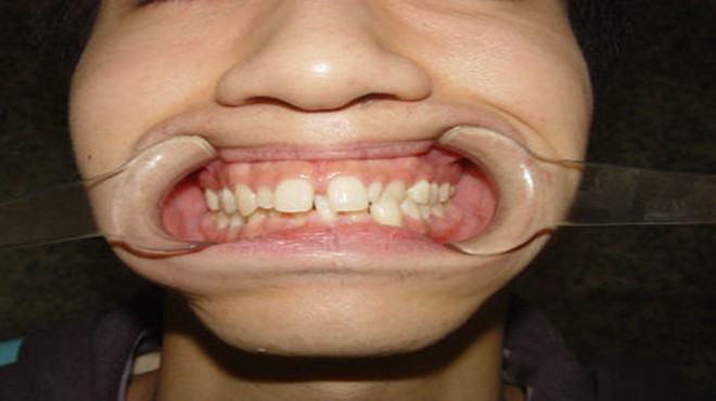 牙齿缝隙大怎么办最有效的办法,牙齿缝隙越来越大怎么补救