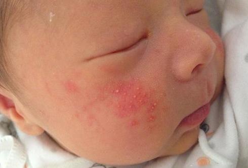 宝宝湿疹安全的偏方,宝宝湿疹用药好了之后怎么预防