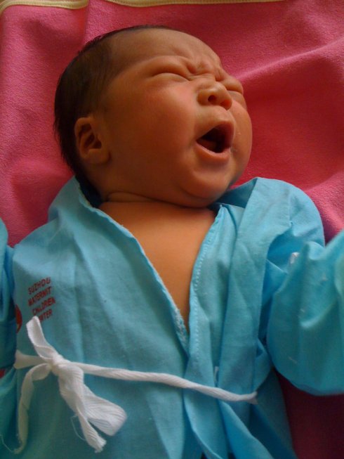 产前备用：快速识别新生儿黄疸症状及解决办法