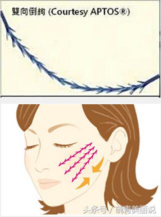 脸垮是先提拉还是填充,脸垮做什么医美没套路