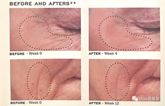 iluminage激光美容仪用法,面部提升紧致美容仪iluminage