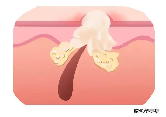 黑头痘痘粉刺脓包囊肿去除过程,脸上频繁长脓包痘痘是什么原因