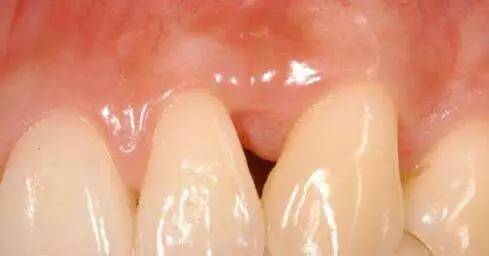 牙线冲牙器哪个好用,牙缝刷好还是牙线好用