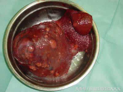 治疗多囊肝的成功案例,肝脏保健与调养论文