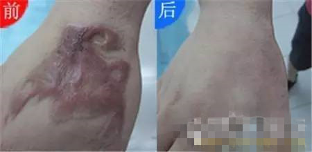 宝宝摔倒的伤疤怎样不留疤痕,宝宝摔倒怎么不留疤