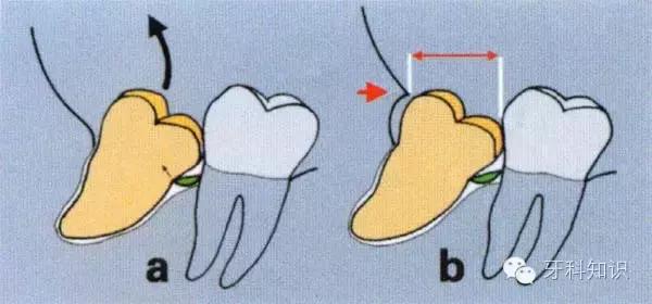 口腔拔牙图片,口腔拔牙麻醉多久消退