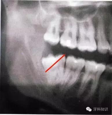 口腔拔牙图片,口腔拔牙麻醉多久消退