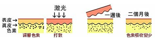 遗传雀斑激光会反弹吗,海口祛雀斑激光不反弹哪个医院好