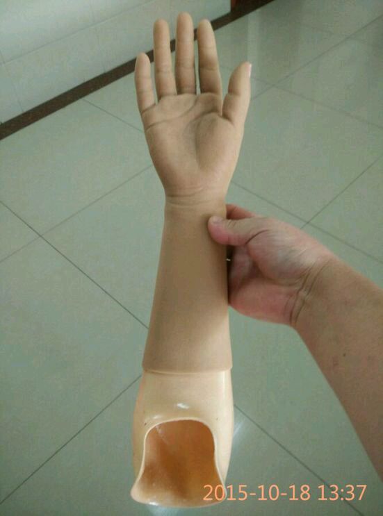 截肢后戴假肢老是疼怎么处理,截肢病人注意事项