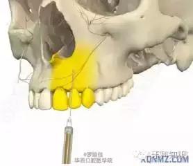 口腔拔牙图片,口腔拔牙麻醉多久消退