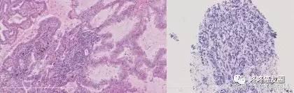 对AZD9291耐药的肺癌，到底该怎么办？