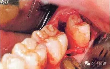 口腔拔牙图片,口腔拔牙麻醉多久消退