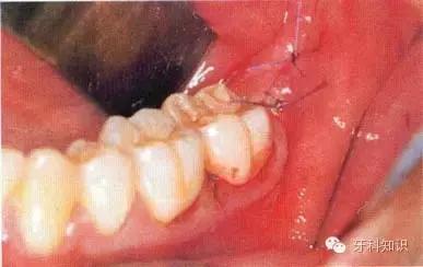 口腔拔牙图片,口腔拔牙麻醉多久消退