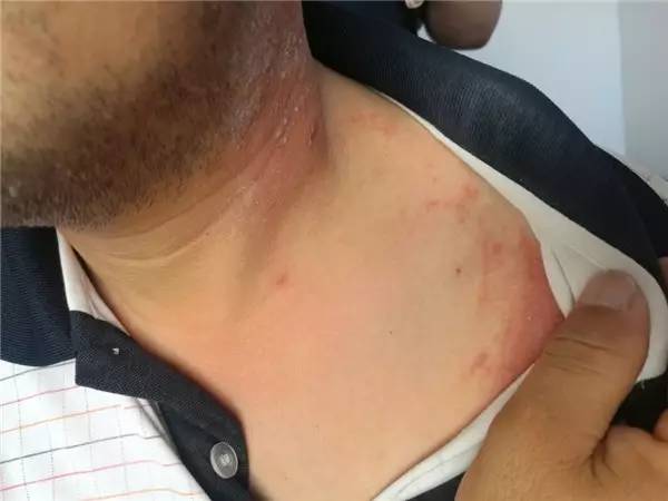 隐翅虫拍死要不要洗,隐翅虫被拍死后用什么药