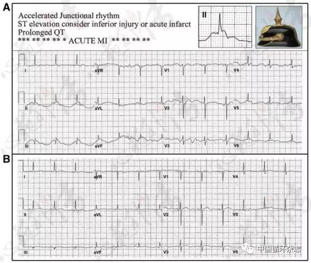 心电图军检常见问题,心电图标志