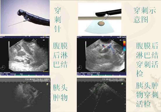 超声内镜检查是什么意思,超声内镜一般多少钱