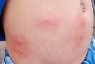 夏天身上总是各种「包」，对症下药，还你滑嫩肌肤！