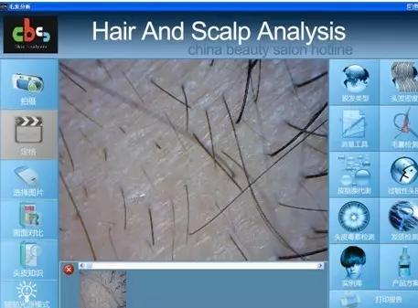 毛囊检测可以查出脱发原因吗,毛囊检测都是正常脱发还有救吗