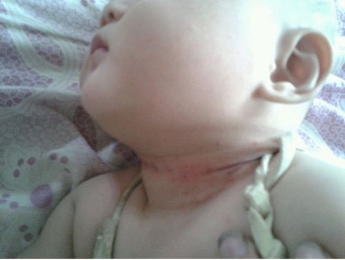 宝宝夏天淹脖子用什么好,夏季宝宝淹脖子怎么办