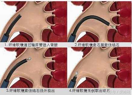 肾和尿路结石怎么预防,肾石通可以治输尿管结石吗