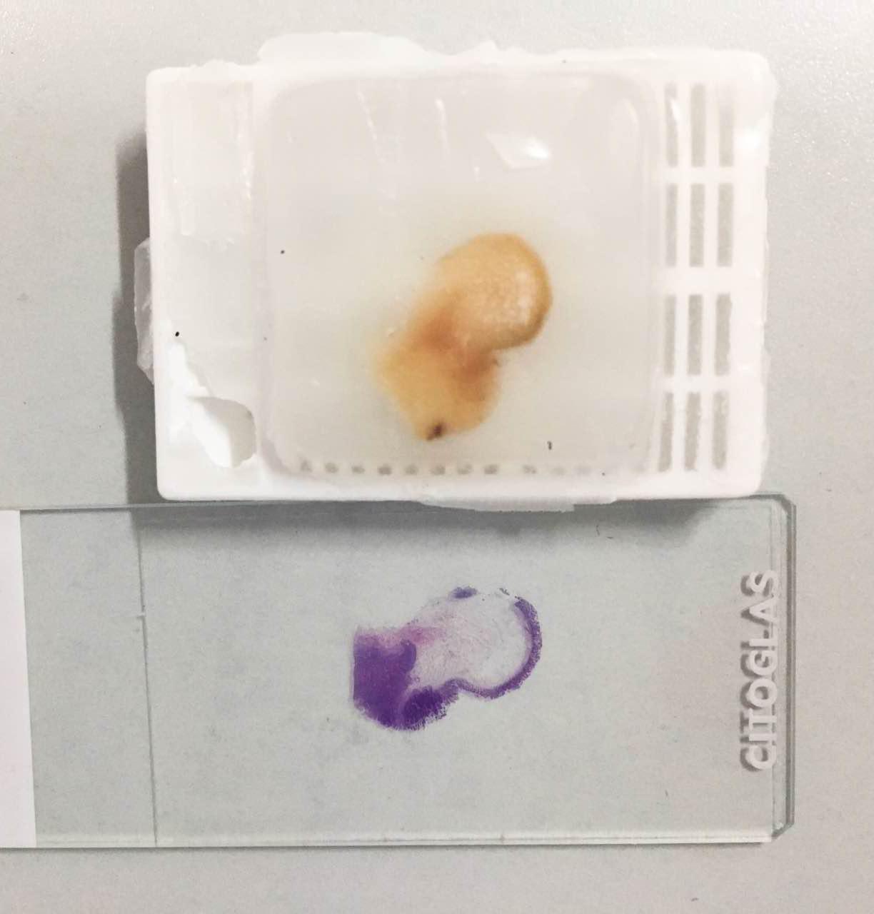 那些年身上切下的肉肉去哪了——记病理是个什么鬼