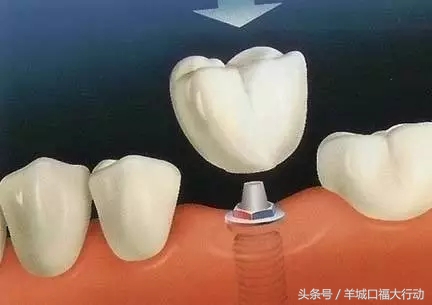 种植牙的八大优势你知道吗,种植牙的优势动画视频