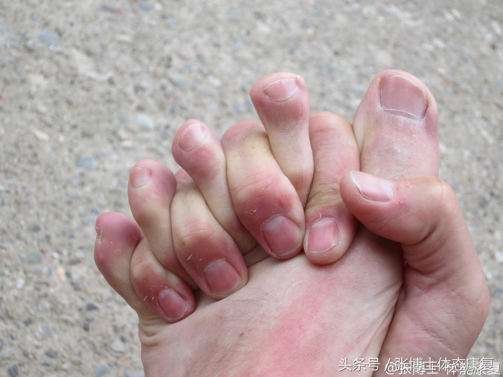 怎么站立可以改善足弓塌陷,如何站立练背