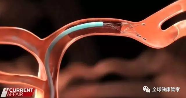 澳洲治疗中风可怕副作用,澳洲十大黑科技药