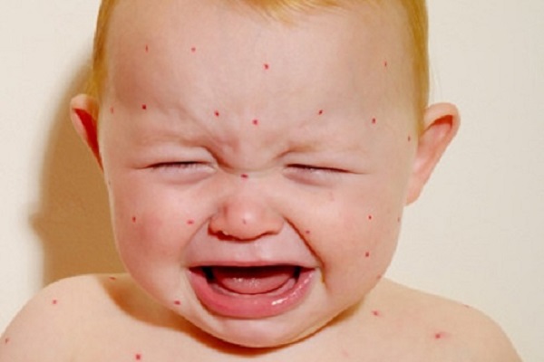宝宝哭闹脸上起湿疹怎么回事,婴儿脖子有湿疹会一碰就哭闹