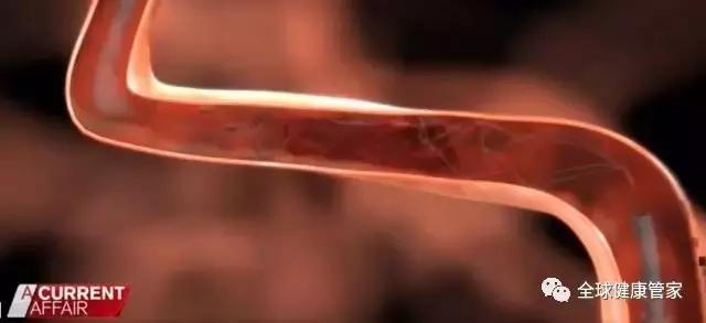 澳洲治疗中风可怕副作用,澳洲十大黑科技药