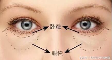 祛眼袋提眉卧蚕费用是多少钱,祛眼袋手术怎么才能不去掉卧蚕