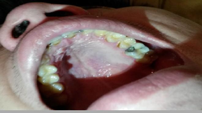 牙齿有大黑洞又痛怎么办,牙齿有黑洞很疼怎么办