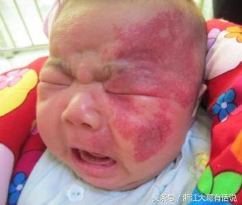 宝宝胎记为何“同记不同命”是因为你陷入了这几个误区