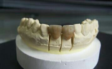 拯救四环素牙,四环素牙的完美蜕变过程