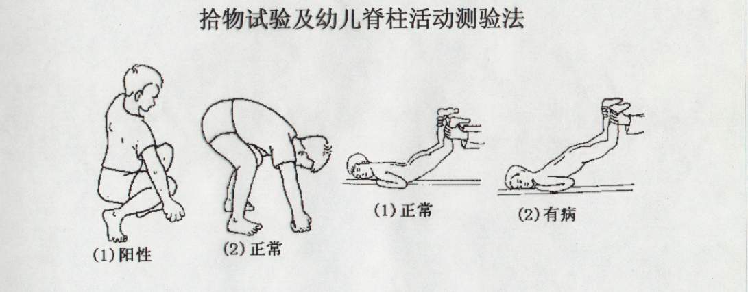 脊柱结核骨质破坏怎么治疗,脊柱结核术后最应注意的并发症