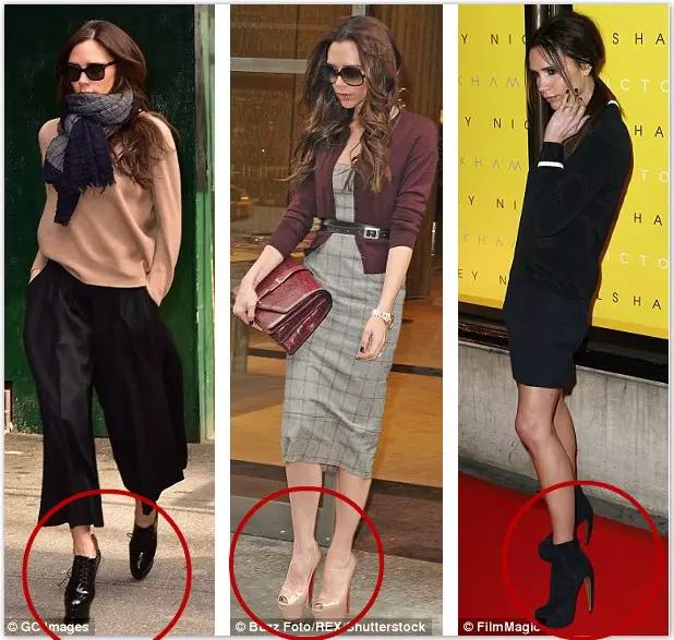 贝克汉姆老婆脚外翻,贝克汉姆老婆的脚拇外翻