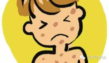 麻疹应该注意什么,麻疹注意事项有哪些