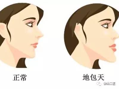 「医生说」“地包天”不容忽视口腔正畸专家提醒，越早接受治疗效果越好