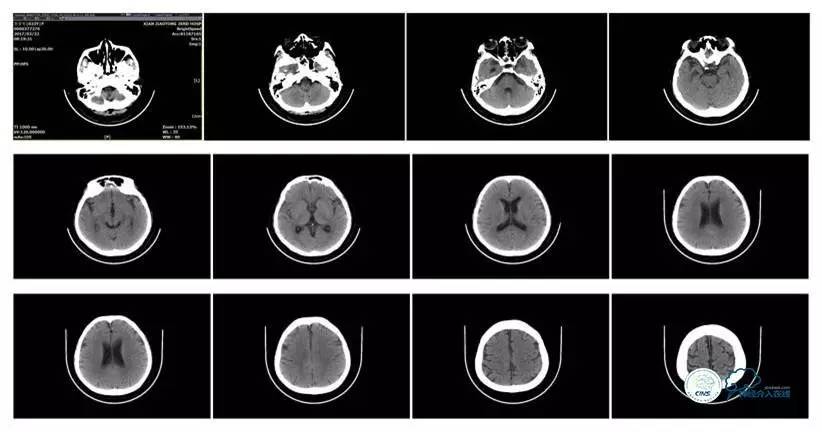 静脉窦狭窄支架植入术,静脉窦狭窄做支架多少钱