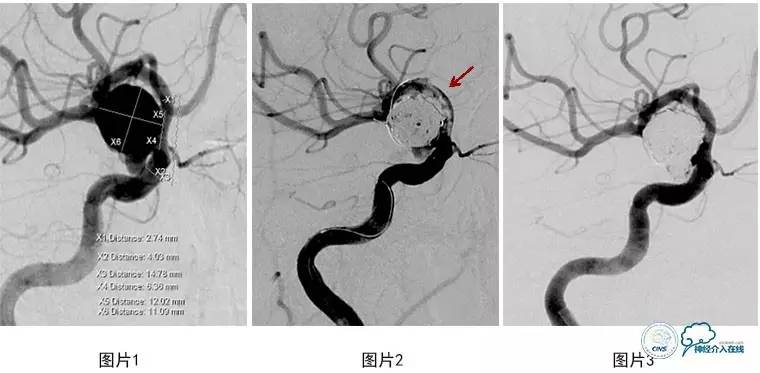 颅内动脉瘤血管内治疗的缺血性并发症